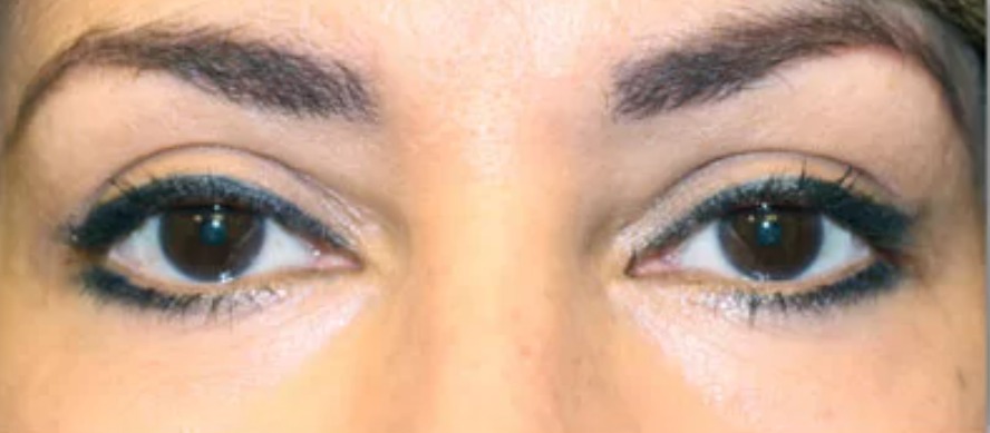 After Eyes - Front View